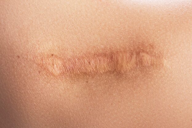 Caring for Your ACDF or ADR Surgery Scar