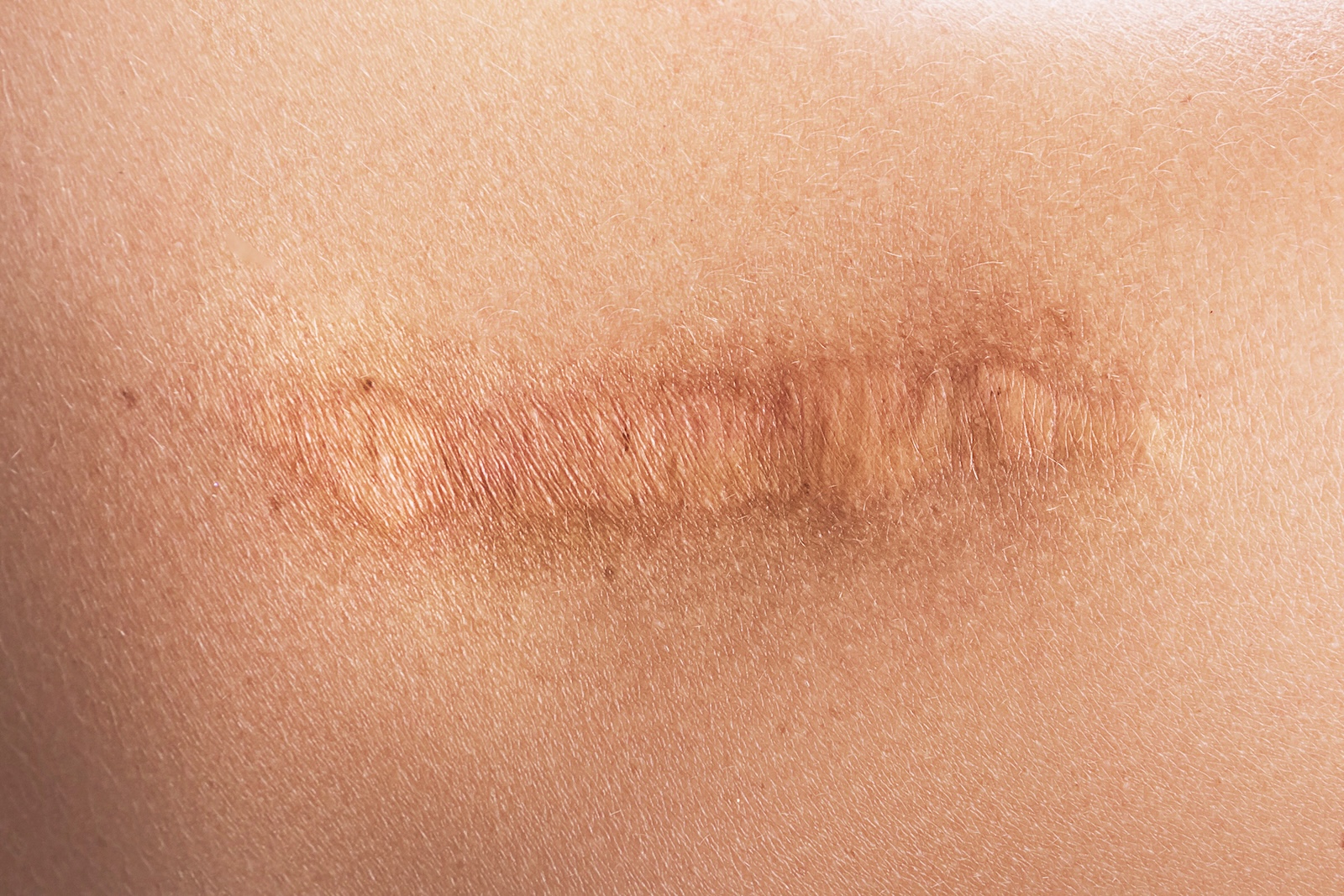 Caring for Your ACDF or ADR Surgery Scar
