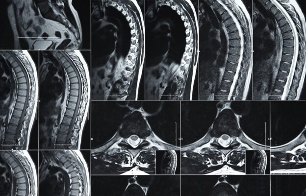 How MRI Scans Diagnose Spinal Conditions (and When To Get One)