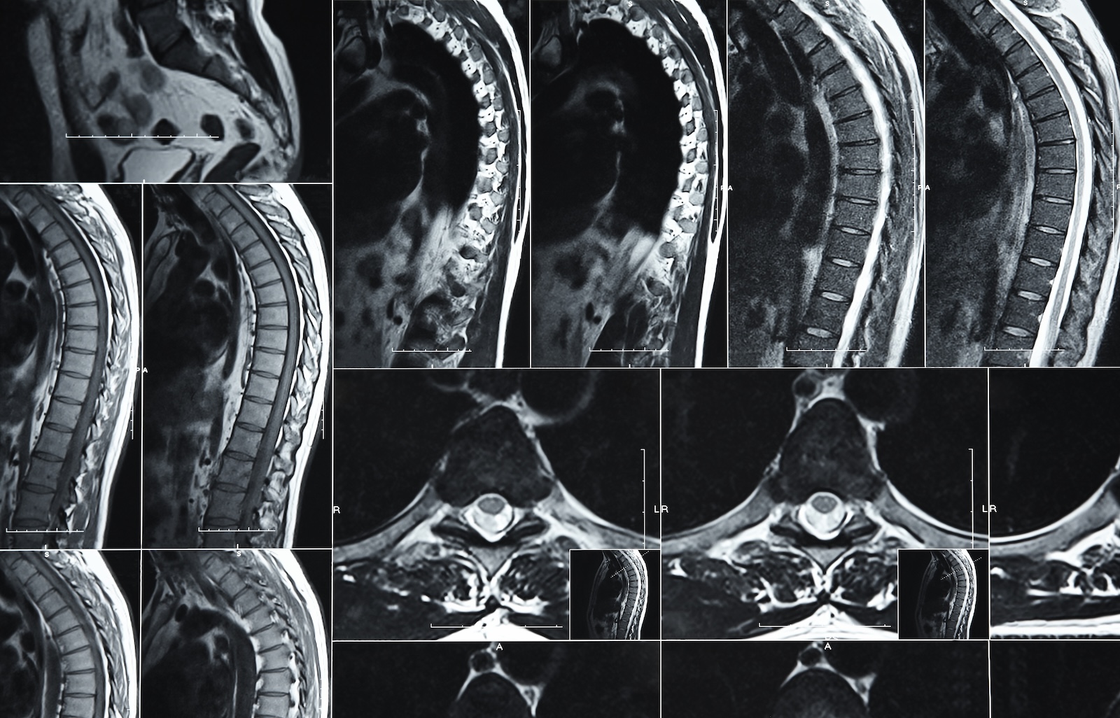 How MRI Scans Diagnose Spinal Conditions (and When To Get One)