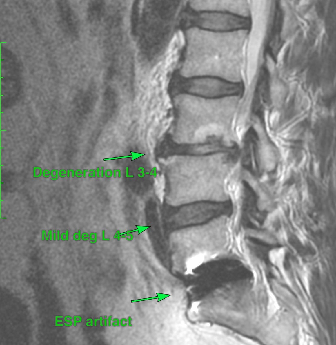 Replacing a Failed Viscoelastic-Core Lumbar Disc While Preserving Motion